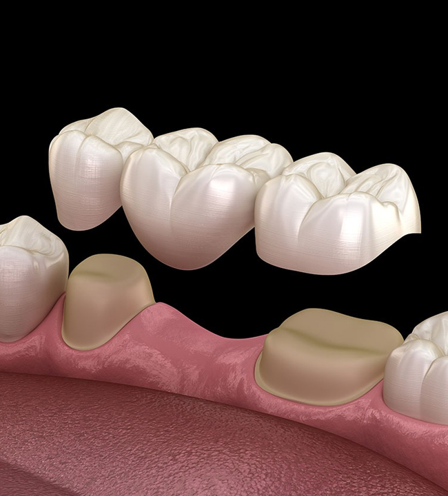 Dental Bridge Replace Missing Tooth - Grande Dentistry