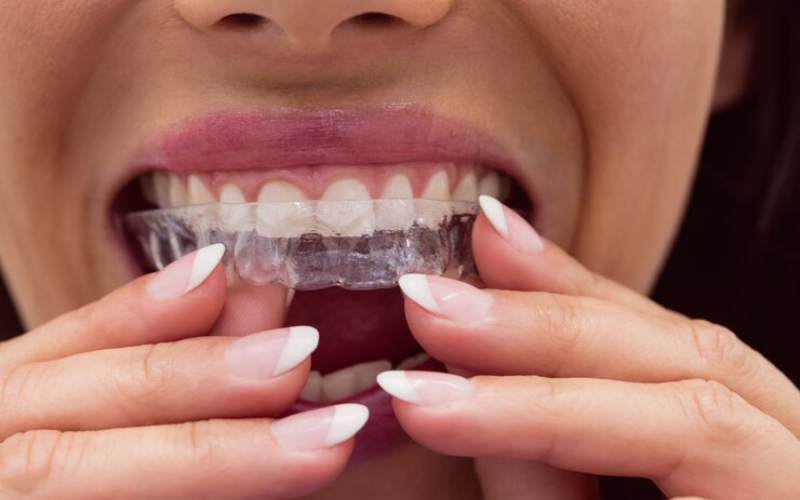How Invisalign Dentist Can Correct Common Dental Issues